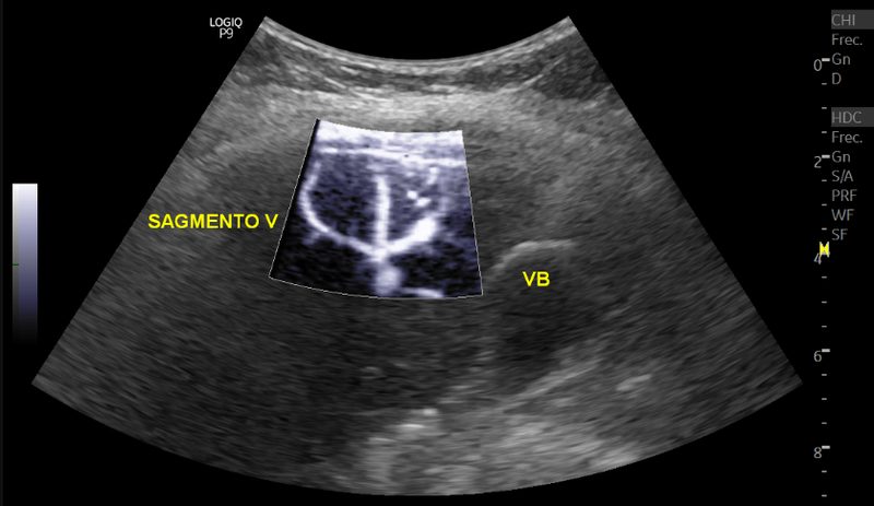 Ultrasonido hepatobiliar