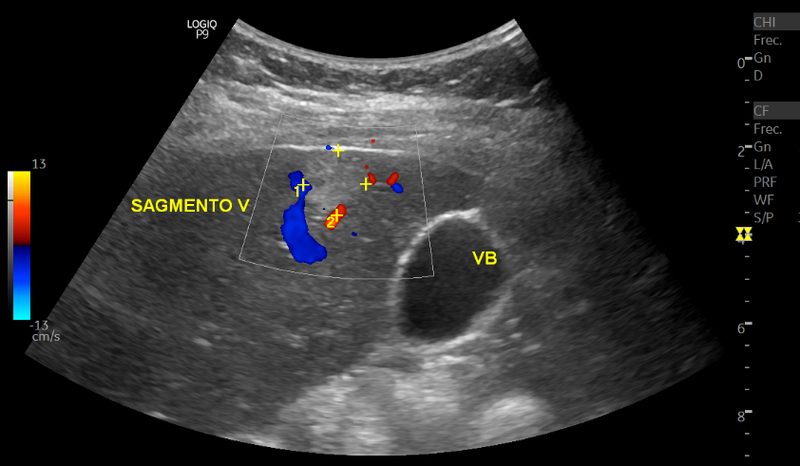 Ultrasonido Doppler de vesícula biliar