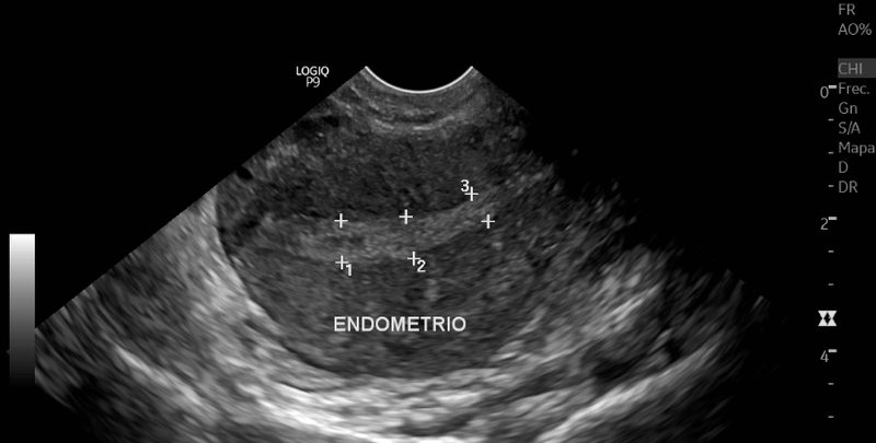 Ultrasonido Doppler carotídeo