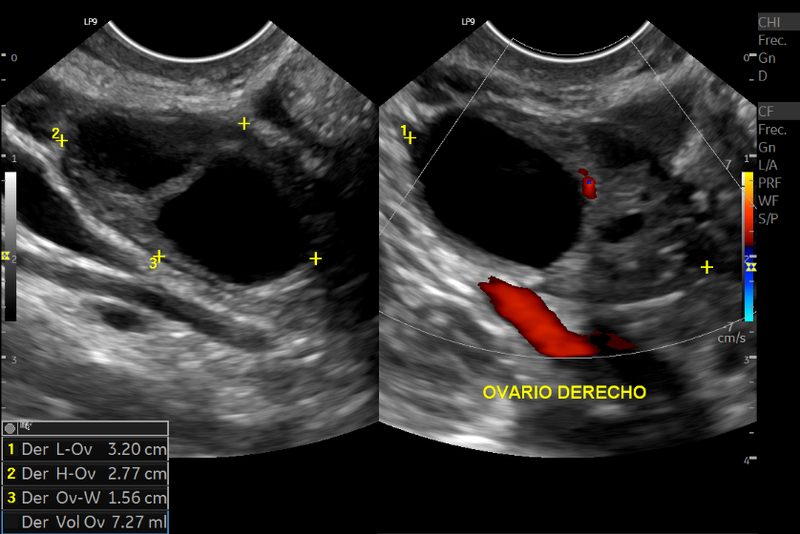 Ultrasonido endovaginal, endometrio