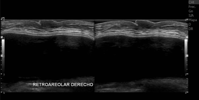 Ultrasonido inguinal, hernia