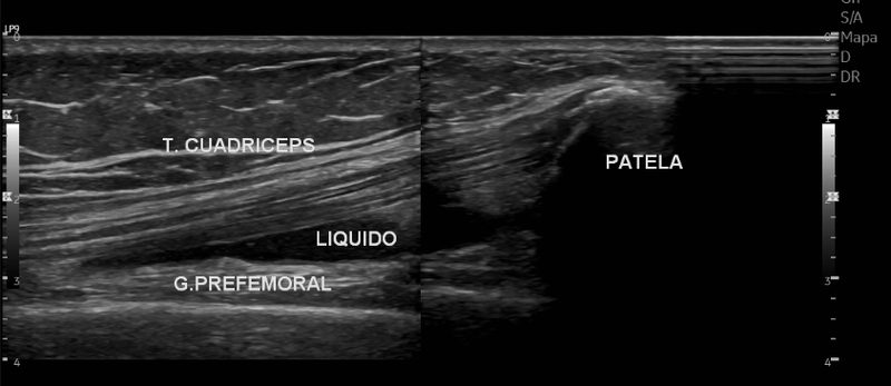 Ultrasonido musculoesquelético de rodilla