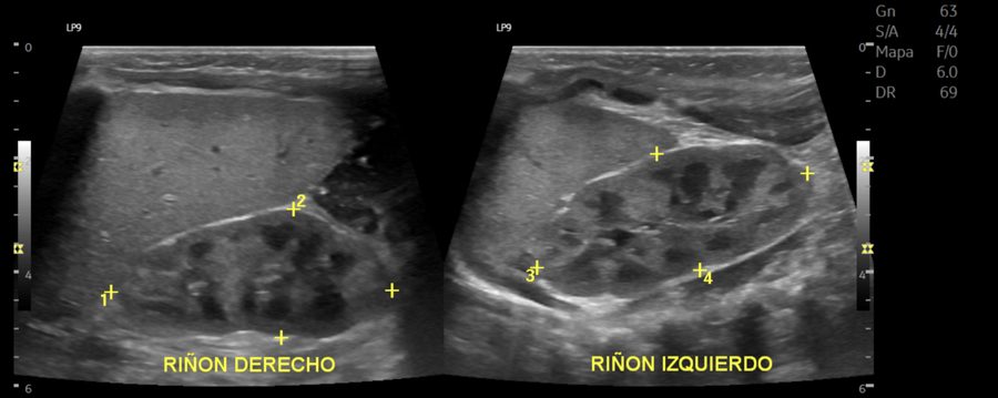 Ultrasonido renal bilateral